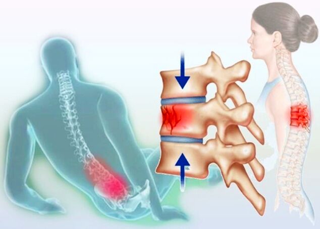 Tudi običajna poškodba lahko sproži razvoj osteohondroze